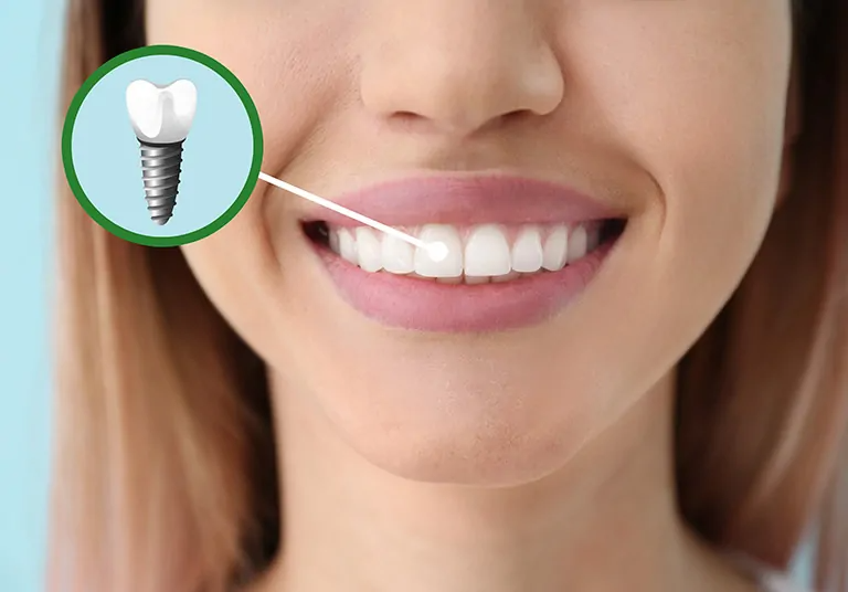 Dental Implants: Surgery, Advantages, Risks, And Insurance Considerations